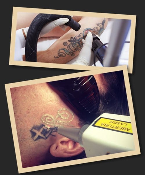 Лазерний метод справляється з усіма видами татуювань