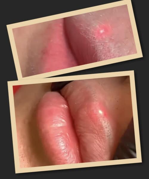 Переваги виведення татуажу лазером