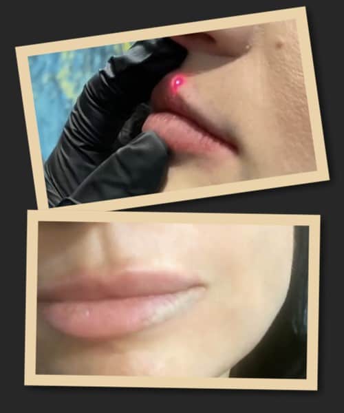 ефективність зведення перманентного макіяжу лазером