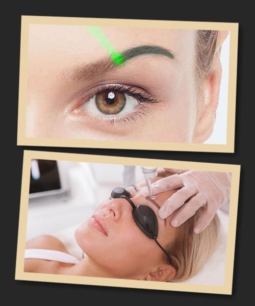 Як діє лазер при видаленні татуажу