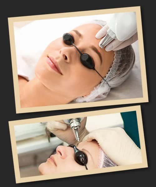 Переваги лазерного методу видалення татуажу брів