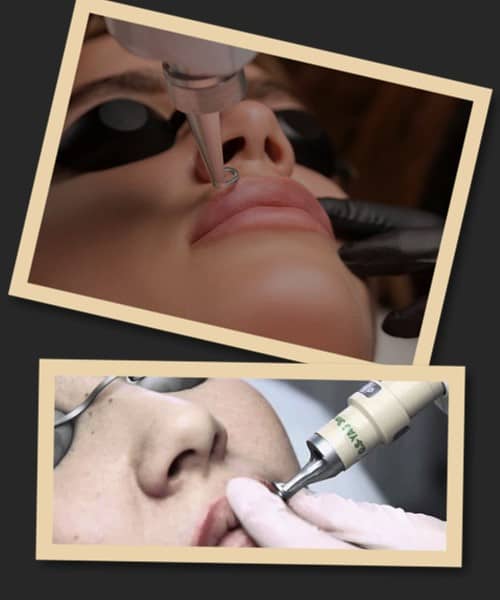 Як видалити татуаж губ