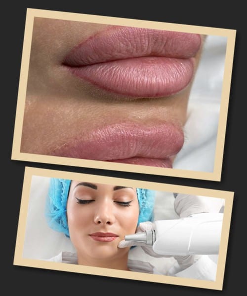 Лазером можна видалити татуаж губ