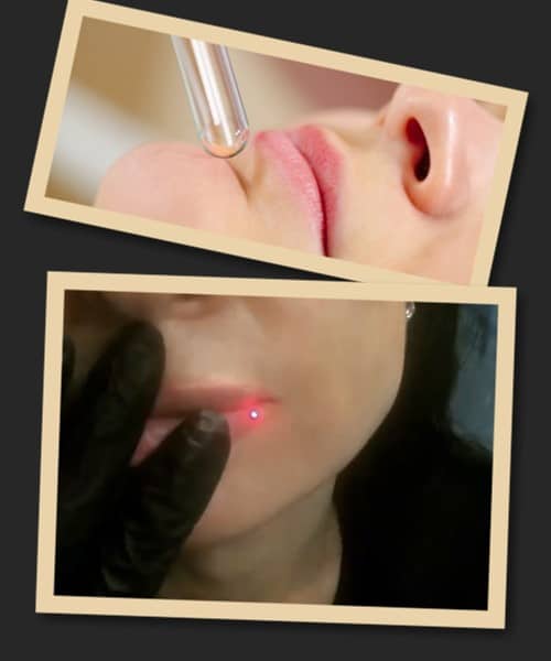 виведення татуажу губ