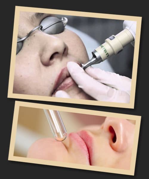 видалення татуажу губ