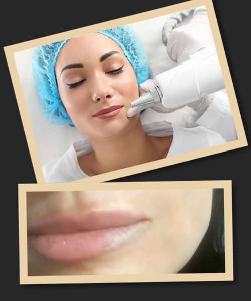 Що краще – ремувер чи лазер?