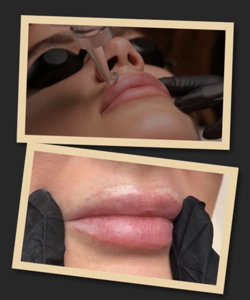 Способи видалення татуажу губ