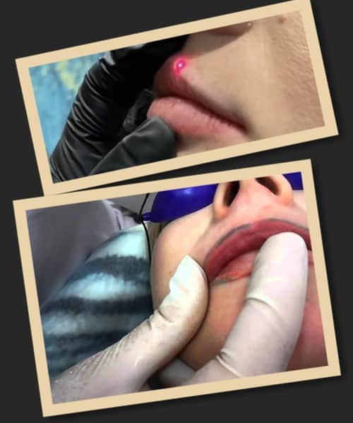 Що робити з невдалим татуажем губ