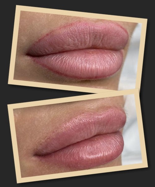 виведення татуажу губ лазером