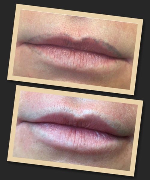 видалення татуажу лазером