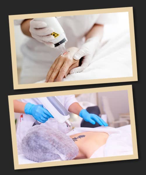 Як вивести татуювання з тіла