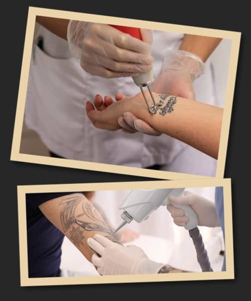 Чому варто вибрати лазерне видалення