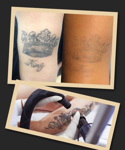 видалення татуювань