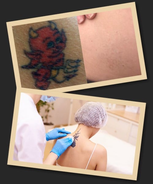 Як вивести татуювання без ризику