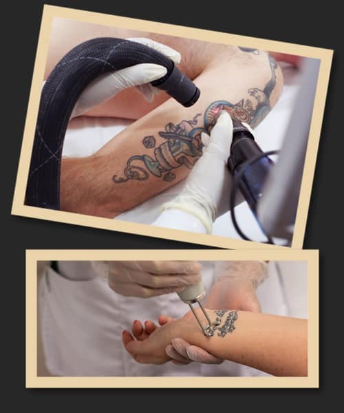 Як працює лазерний апарат для видалення тату