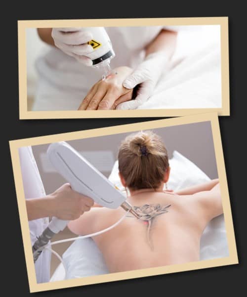 Як виводять тату лазером