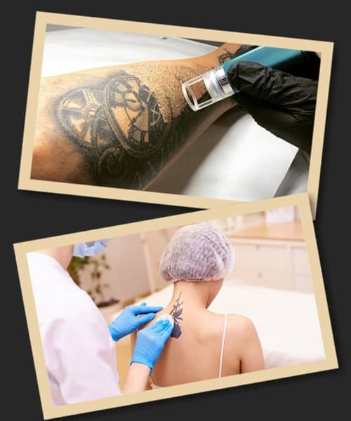 Лазерне видалення татуювань