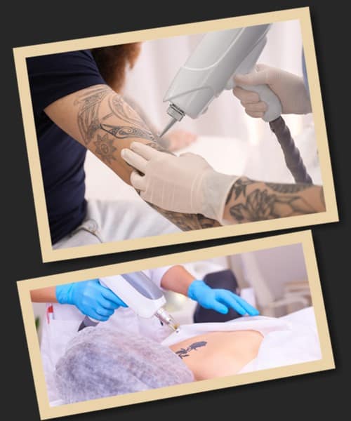 Переваги лазерного методу видалення тату