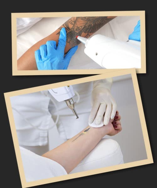 як видалити тату лазером