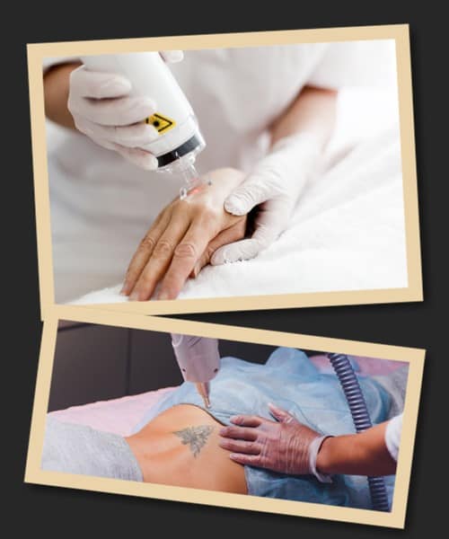 Як позбутися татуювань