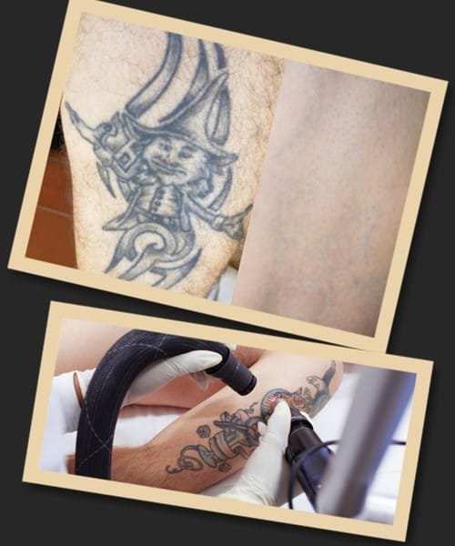 лазерна обробка татуювань