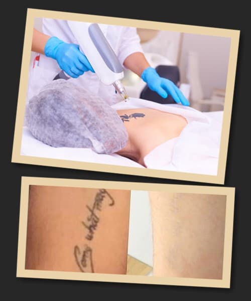 Методи видалення татуювань