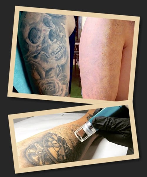 використання лазера для видалення тату