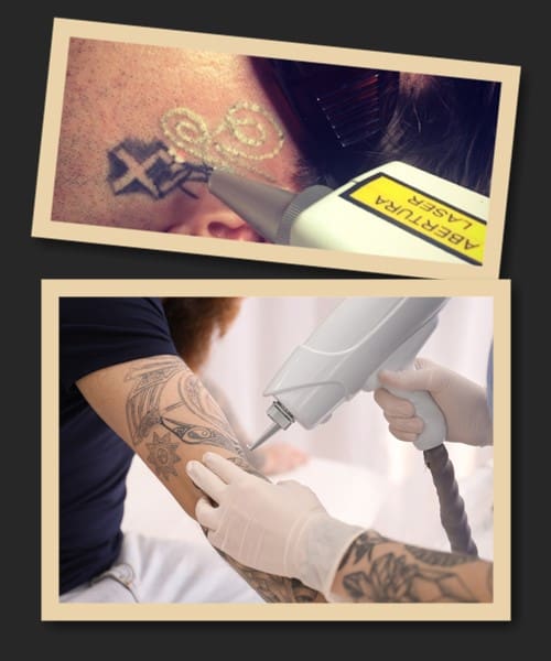 позбутися тату у Києві
