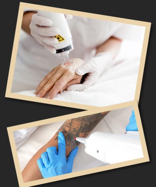 Як позбутися татуювання без шрамів