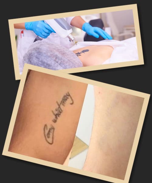 видалення татуювань лазером