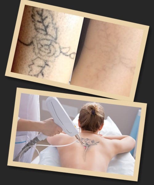 Лазерний метод виведення тату