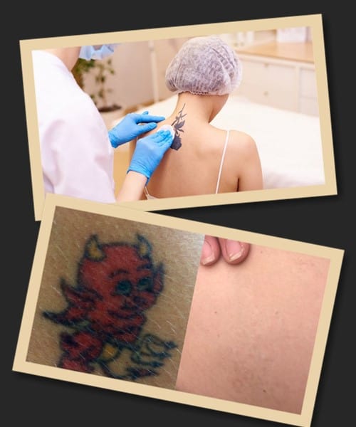 виведення тату без шрамів