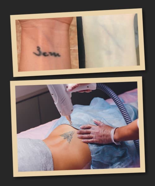 позбутися татуювання без шрамів