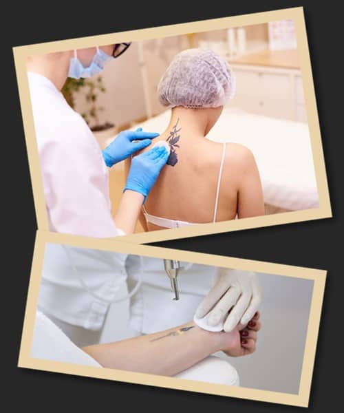 Яким лазером краще видаляти татуювання