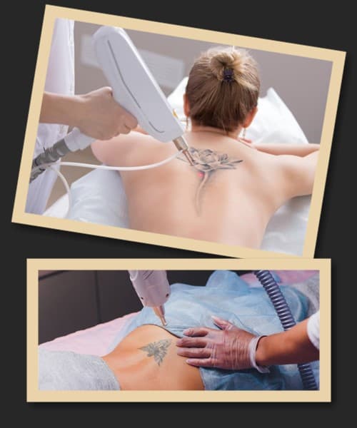 Неодимовий лазер видалення тату