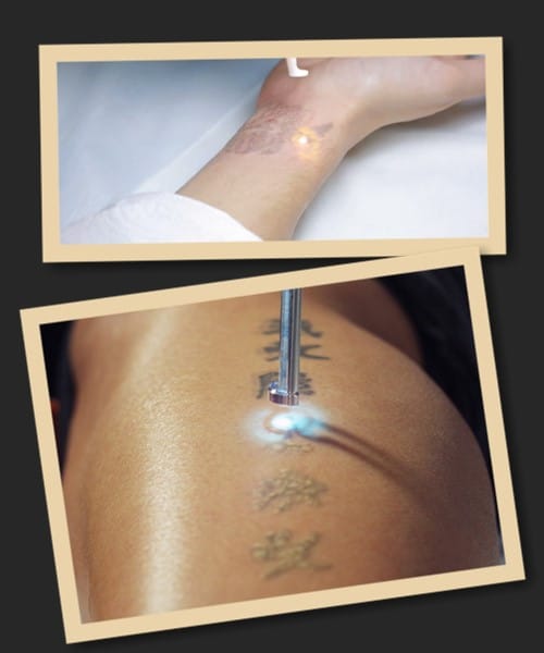 виводити тату лазером