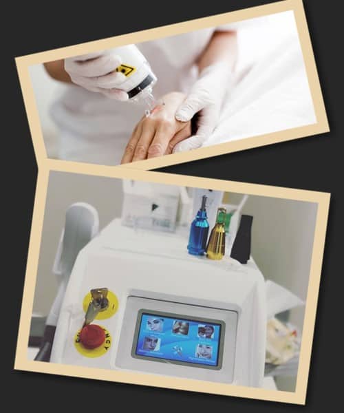 Принцип дії лазера при видаленні тату