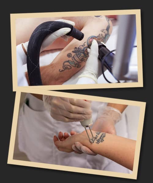 видалити тату лазером