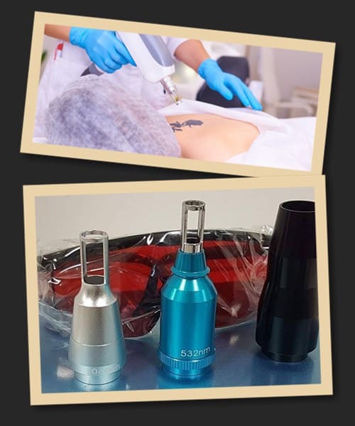 технологія Q-SWITCH видалення тату