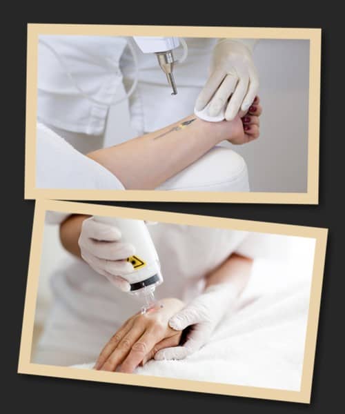 Все про лазерне видалення тату