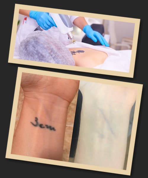 Лазерне видалення тату