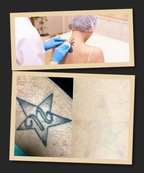 При лазерному видаленні тату