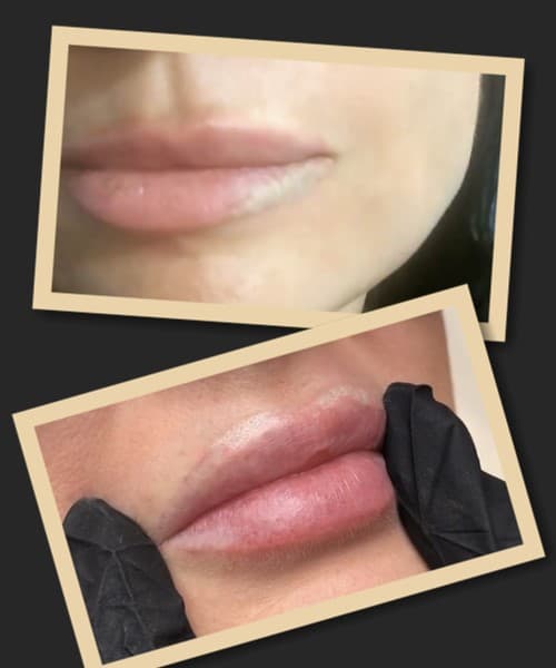 Видалення перманентного макіяжу губ лазером у Києві
