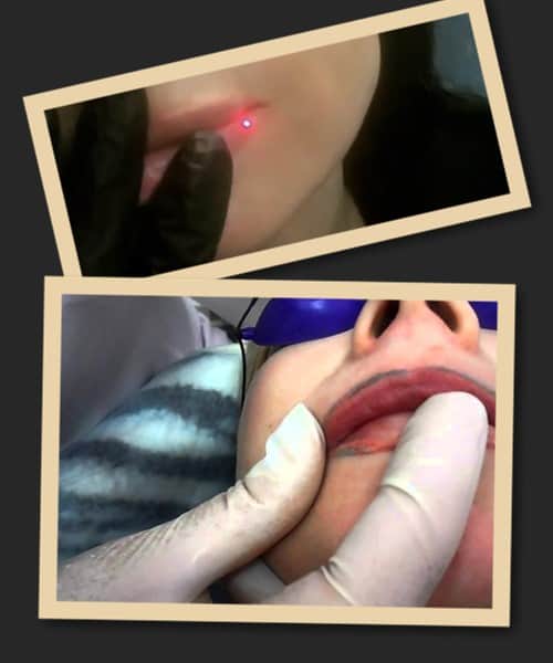 видалення татуажу за допомогою лазера