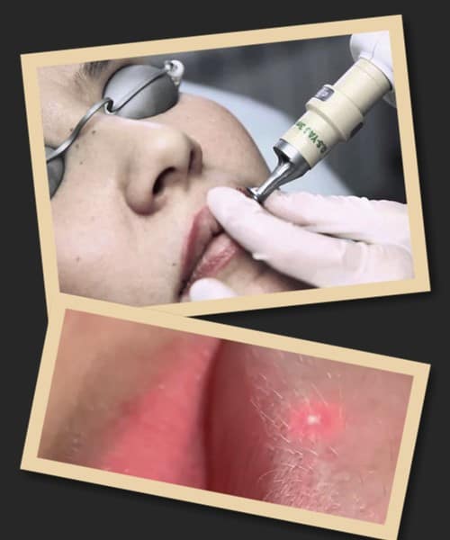 лазерне видалення татуажу губ