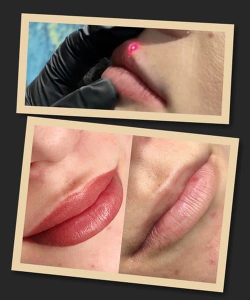 Лазерне видалення татуажу губ
