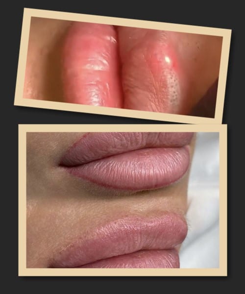 Результат лазерного видалення перманентного макіяжу губ
