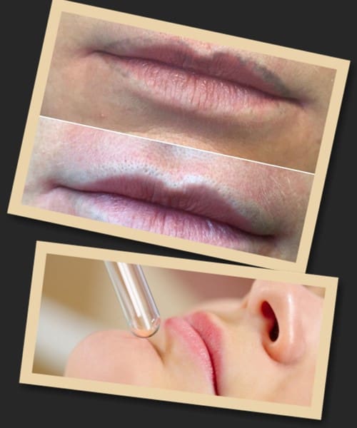 видалення татуажу губ