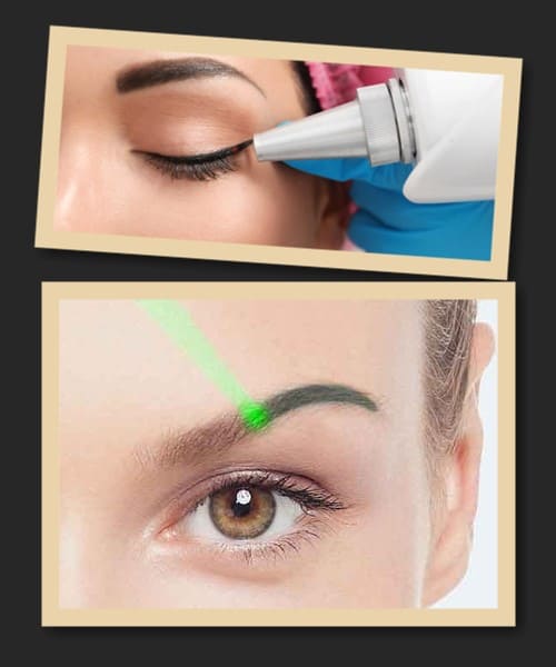 Причини виведення татуажу