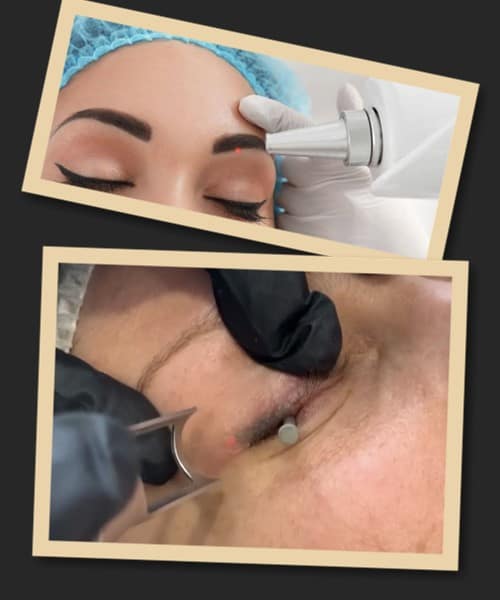 Лазерне видалення татуажу